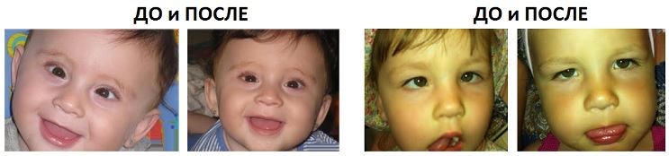 Фотографии детей после операции по коррекции косоглазия